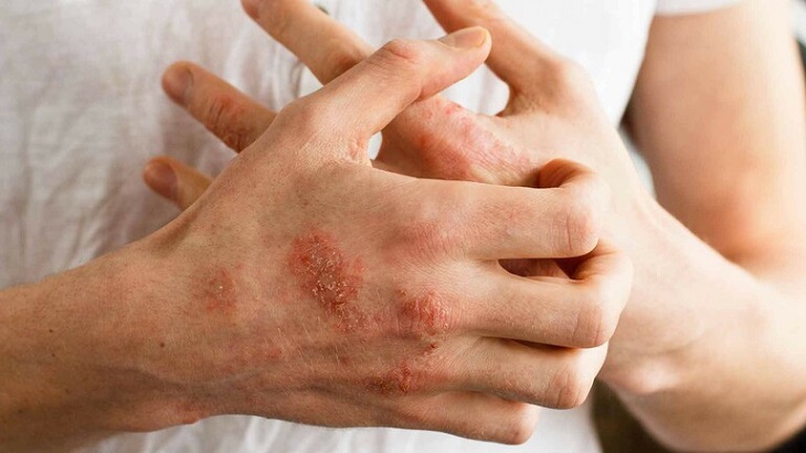 Triệu chứng viêm da cơ địa
