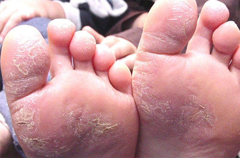 Bệnh á sừng là một trong những bệnh da liễu thường gặp hiện nay