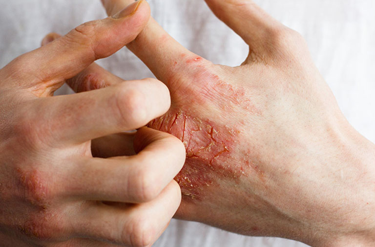 Tuyệt đối không gãi khu vực da bị viêm