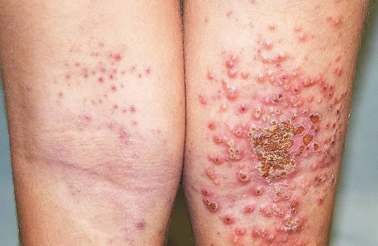 Bệnh chàm là một tổ hợp các bệnh viêm da hoặc kích ứng