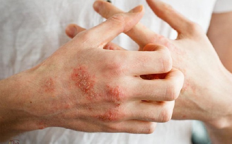 Chàm bàn tay gây khó khăn, bất tiện trong công việc, sinh hoạt