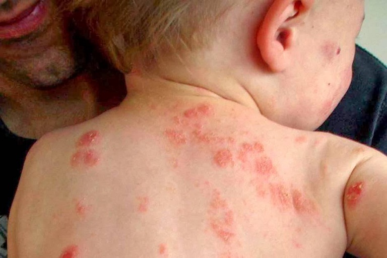 Nếu để lâu không điều trị hoặc chữa sai cách có thể khiến bệnh trở nặng, khó kiểm soát hơn