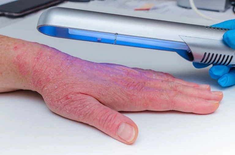 Liệu pháp tia cực tím giúp trị bệnh nhanh chóng