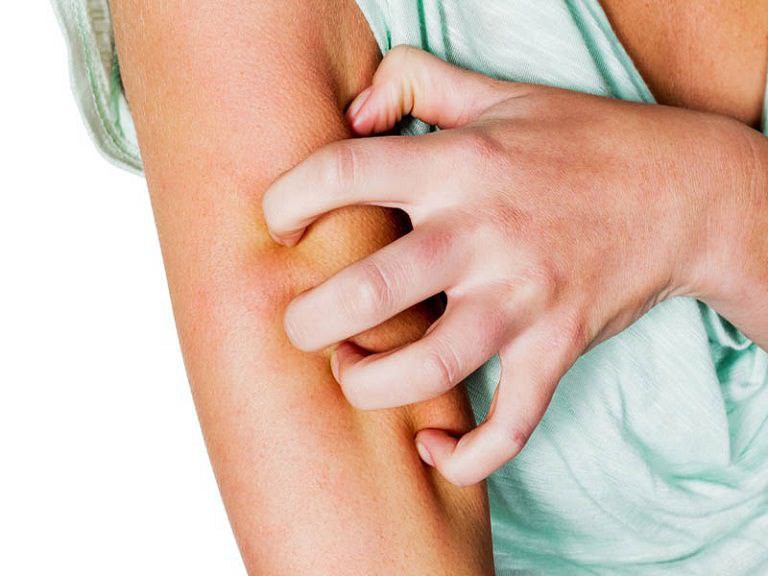 Không cào gãi lên da để tránh bị tổn thương, làm tăng nguy cơ nhiễm trùng