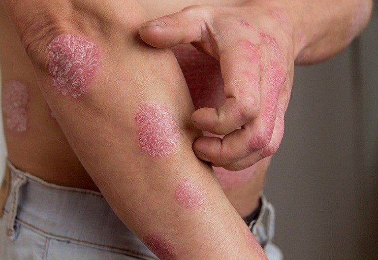 Bệnh chàm có lây không là vấn đề được nhiều người quan tâm
