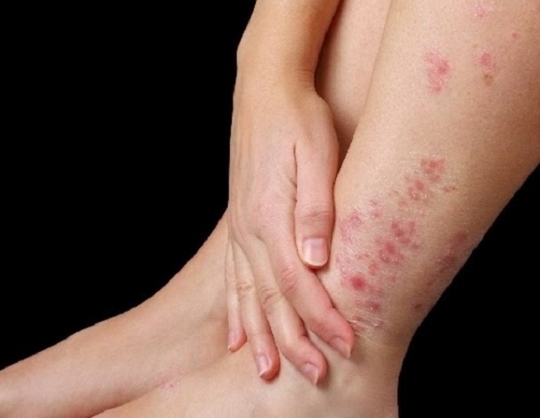 Hình ảnh bị chàm ở chân