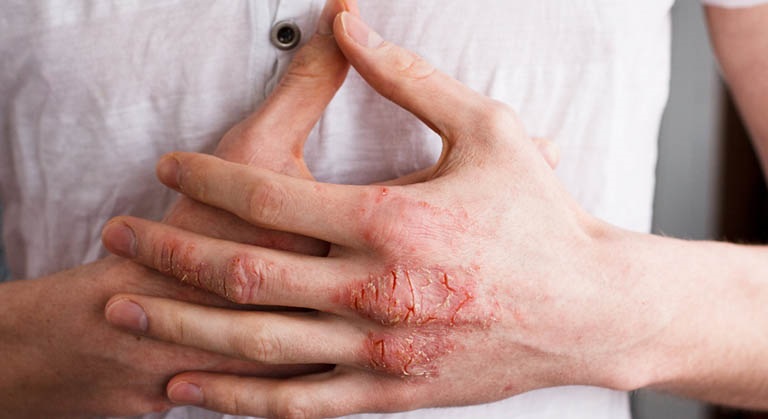 Hình ảnh bị chàm ở tay