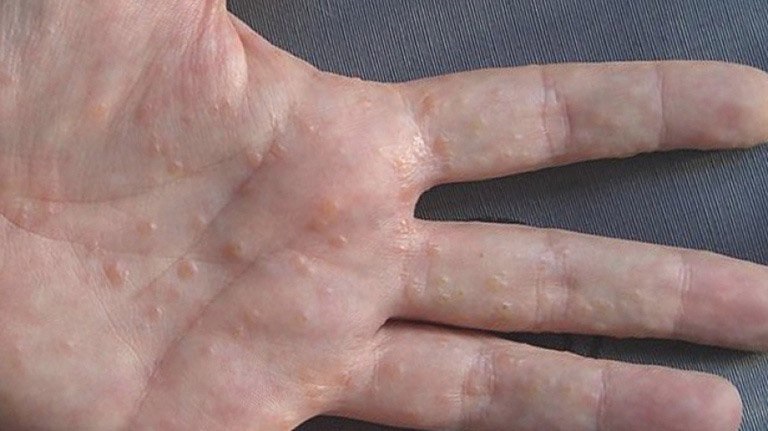 Tổ đỉa (Dyshidrosis) là bệnh viêm da có chứa các mụn nước nhỏ