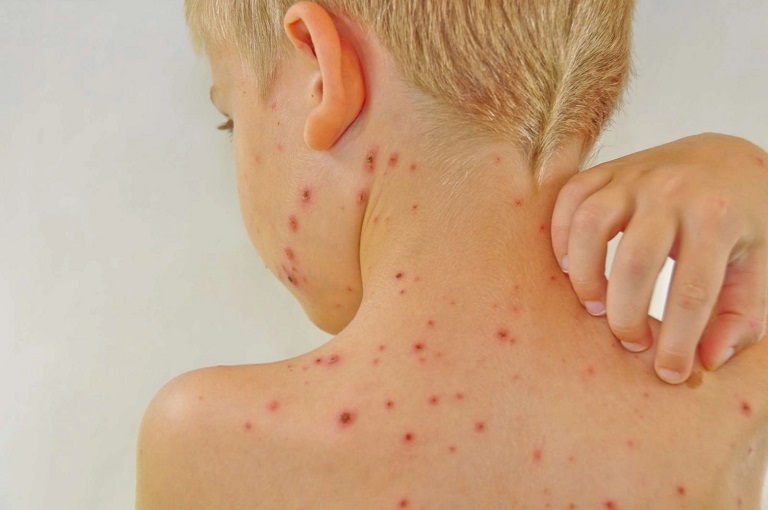 Các triệu chứng bị viêm da ở trẻ nhỏ