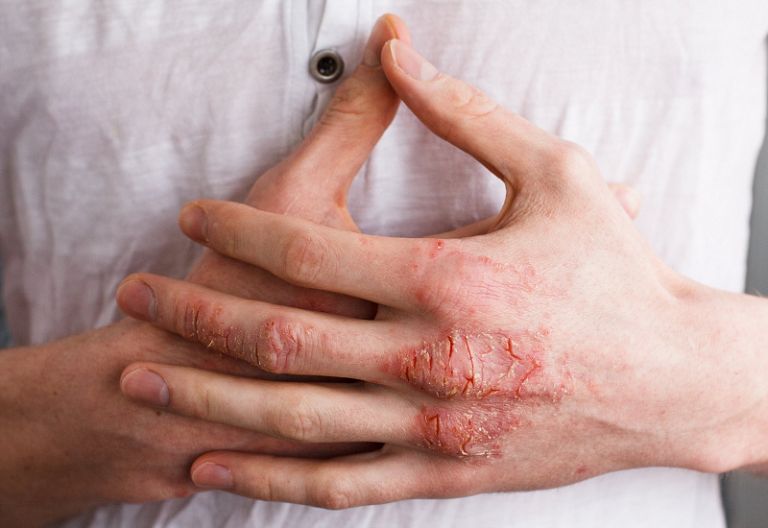 Triệu chứng điển hình của căn bệnh là vùng da tiếp xúc tấy đỏ kèm theo ngứa rát