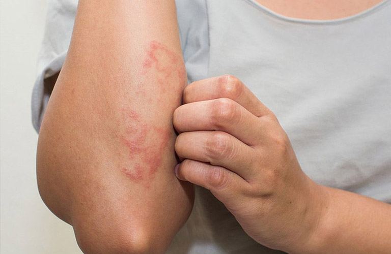 Viêm da dị ứng tiếp xúc bao lâu thì khỏi phụ thuộc mức độ tổn thương