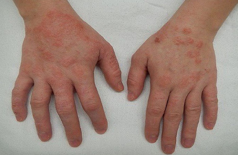 Viêm da tiếp xúc dị ứng bao lâu thì khỏi phụ thuộc vào phương pháp chăm sóc