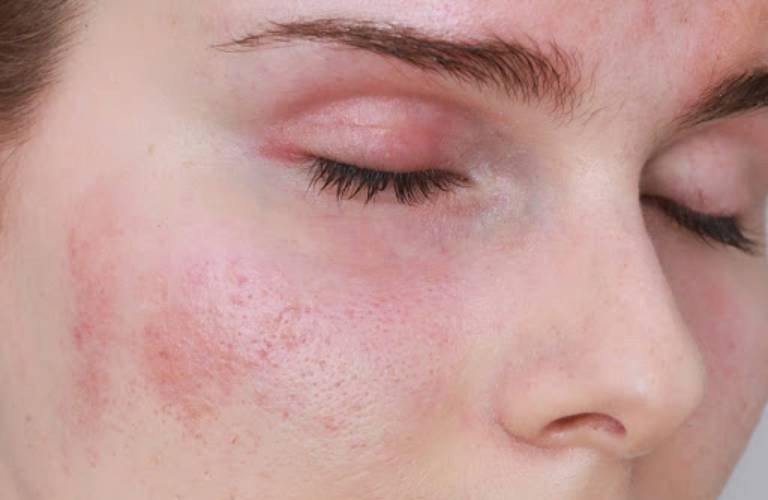 Viêm da dị ứng ở mặt là một trong những dạng của bệnh lý viêm da tiếp xúc