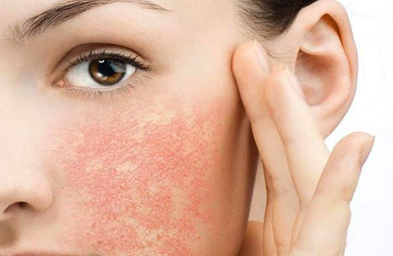 Dùng mỹ phẩm không rõ nguồn gốc có thể gây viêm da tiếp xúc ở mặt