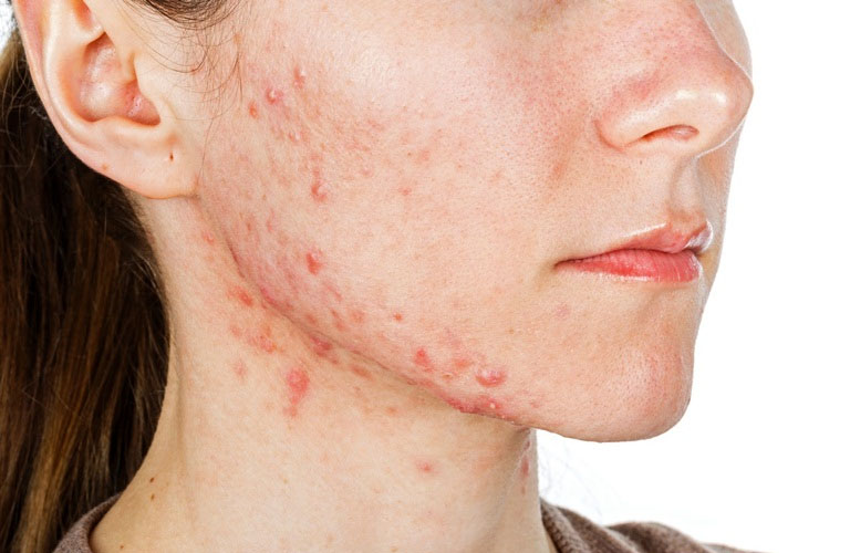 Trên mặt người bệnh có mụn nước kèm theo chảy dịch và đóng vảy