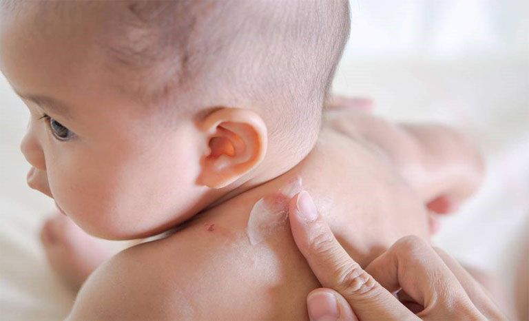 Thuốc bôi được chỉ định để điều trị cho bé mắc viêm da tiếp xúc