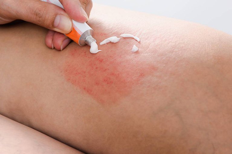 Cách chữa viêm da cơ địa bằng các loại thuốc bôi da