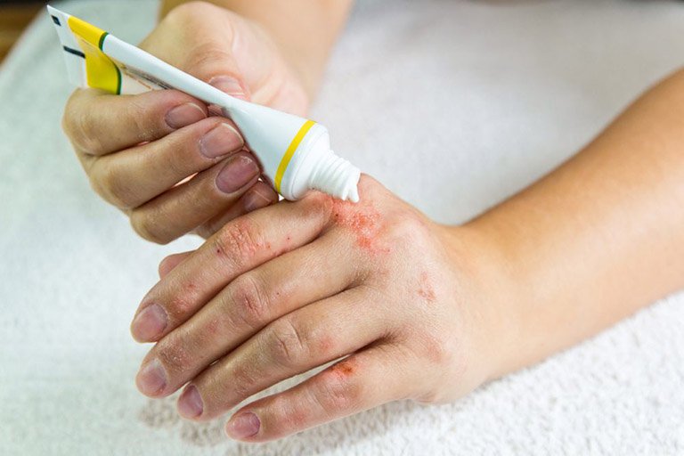 Dùng các loại kem bôi làm mềm da