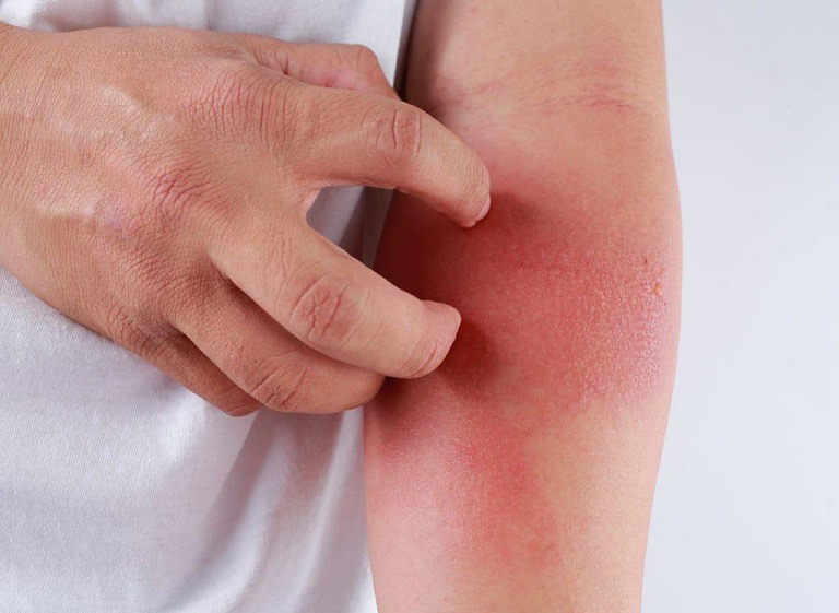 Hướng dẫn cách chăm sóc tại nhà cải thiện viêm da cơ địa