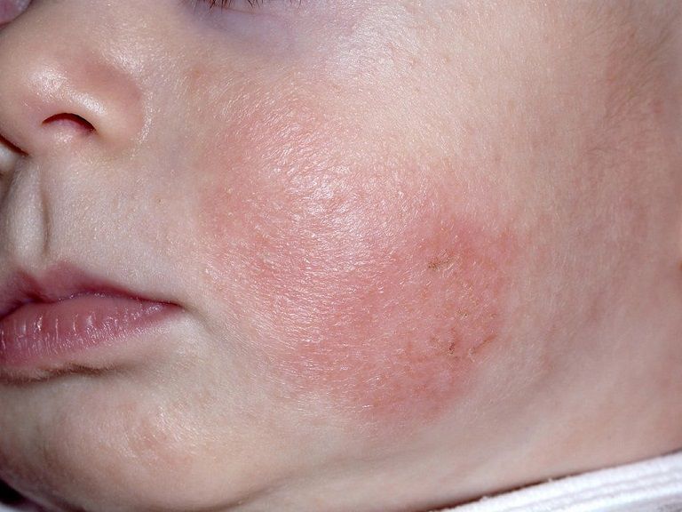 Vùng tổn thương chủ yếu xuất hiện ở 2 bên má