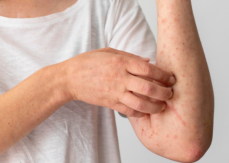 Chữa viêm da cơ địa bằng Đông y là phương pháp được nhiều người áp dụng
