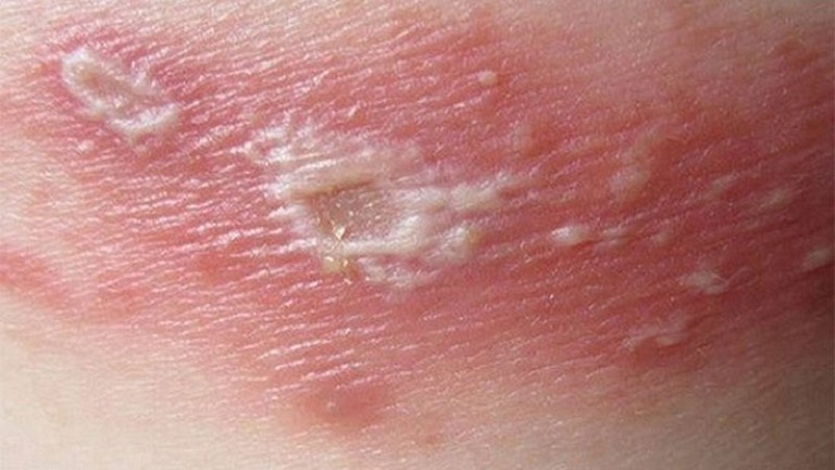 Lưu ý trong quá trình sử dụng thuốc bôi trị viêm da mủ