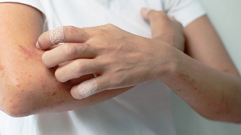 Viêm da dị ứng là bệnh da liễu với nhiều triệu chứng khó chịu