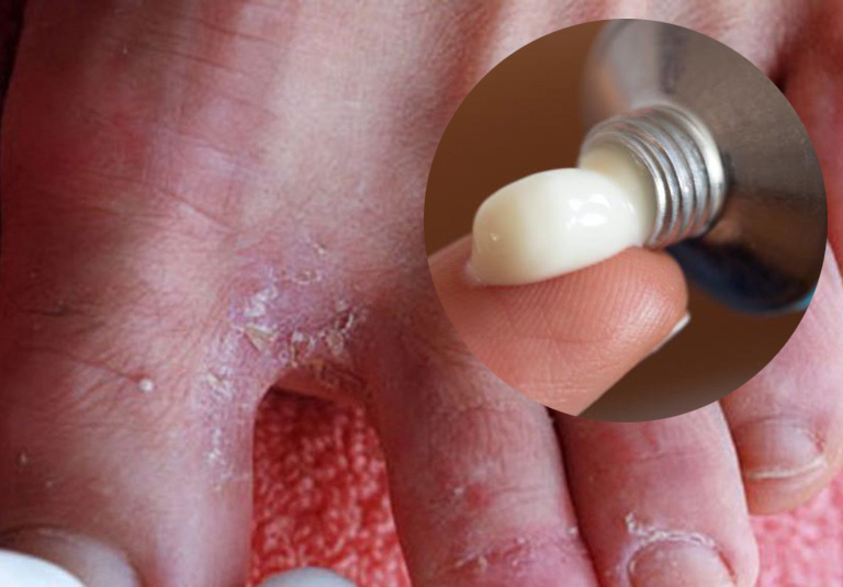 Người bệnh sử dụng các loại thuốc bôi da để giảm ngứa ngáy