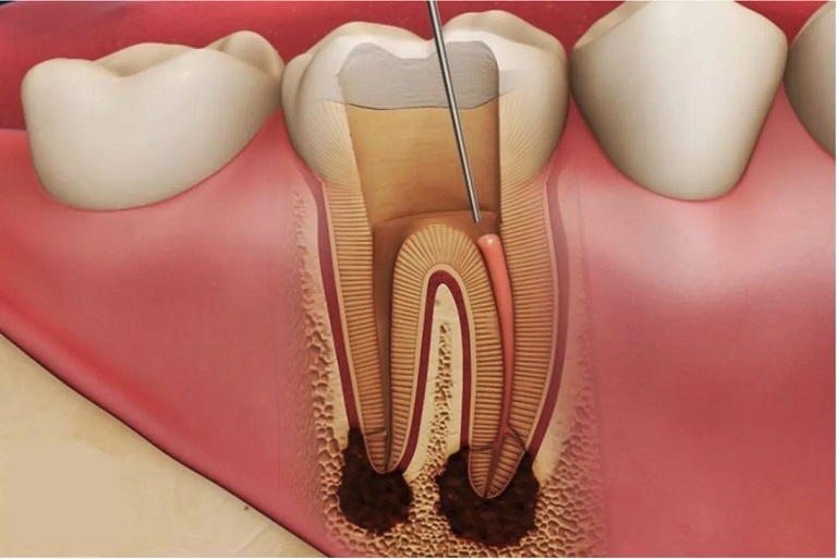 Viêm tủy xương hàm trên là một biến chứng của bệnh viêm xoang hàm