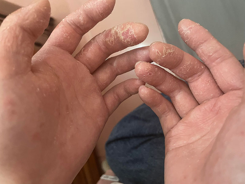 Viêm da cơ địa phổ biến ở trẻ em Viêm da cơ địa phổ biến ở trẻ em