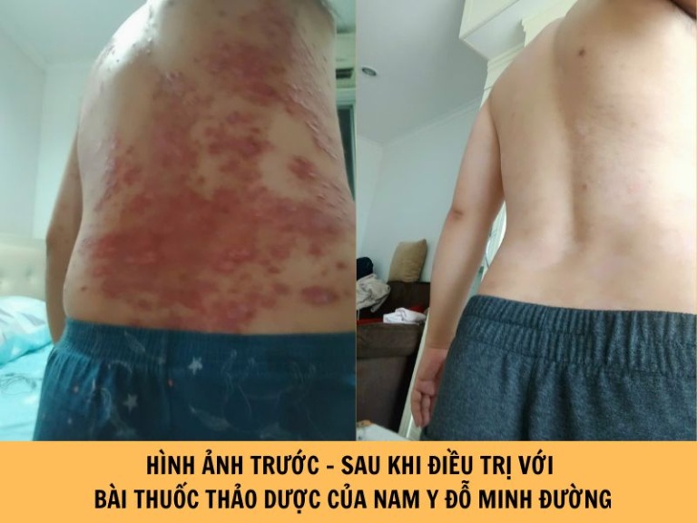 Phản hồi tích cực của người bệnh sau khi dùng bài thuốc thảo dược hỗ trợ điều trị vảy nến từ Phòng khám Nam Y Đỗ Minh Đường