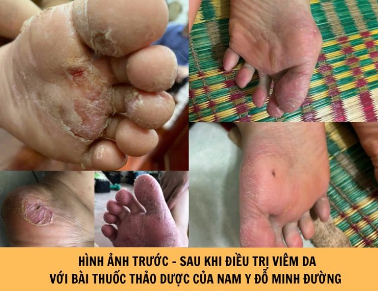 Hình ảnh phục hồi tích cực của người bệnh sau khi điều trị viêm da cơ địa với bài thuốc thảo dược Nam Y Đỗ Minh Đường