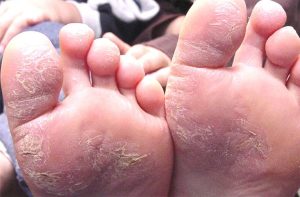 Bệnh Á Sừng: Nguyên Nhân, Triệu Chứng Và Cách Điều Trị