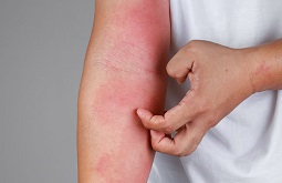 Bệnh Chàm Có Lây Không Và Những Điều Cần Biết?