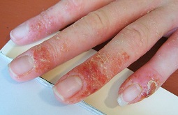 Bị Chàm Ở Tay: Nguyên Nhân, Triệu Chứng Và Cách Điều Trị