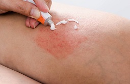 15 Thuốc Bôi Viêm Da Cơ Địa Giúp Bạn Đánh Bay Cơn Ngứa
