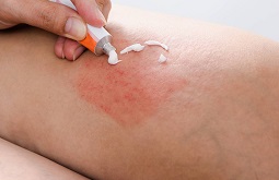 Top 10 Thuốc Trị Bệnh Chàm Hiệu Quả, An Toàn Nhất