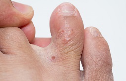Tổ Đỉa Là Gì? Triệu Chứng, Nguyên Nhân Và Cách Điều Trị