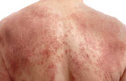 Viêm Da Bội Nhiễm Là Gì? Dấu Hiệu Và Cách Xử Lý An Toàn, Hiệu Quả