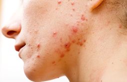Viêm Da Dầu Ở Mặt: Nguyên Nhân, Nhận Biết Và Cách Điều Trị