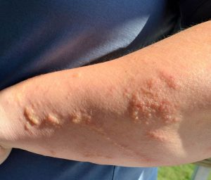 Viêm da tiếp xúc côn trùng là tình trạng viêm da kích ứng gây ra bởi dịch tiết của côn trùng