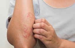 Viêm Da Tiếp Xúc Côn Trùng: Nguyên Nhân, Điều Trị, Phòng Ngừa
