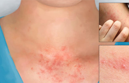 Viêm Da Tiếp Xúc Dị Ứng Bao Lâu Thì Khỏi? Cách Chăm Sóc Tốt