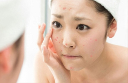 Viêm Da Tiếp Xúc Ở Mặt: Triệu Chứng Và Cách Điều Trị Hiệu Quả