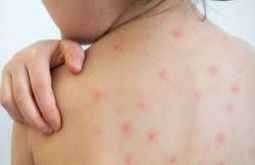 [Giải Đáp] Viêm Da Tiếp Xúc Ở Trẻ Em Là Bệnh Gì