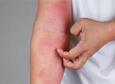 Viêm Da Tiếp Xúc Do Đâu? Triệu Chứng, Điều Trị Và Phòng Ngừa 