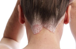 3+ Cách Chữa Bệnh Á Sừng Da Đầu Đơn Giản, Hiệu Quả Nhanh