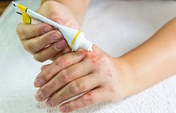4 Cách Chữa Viêm Da Cơ Địa Phổ Biến Bác Sĩ Khuyên Dùng