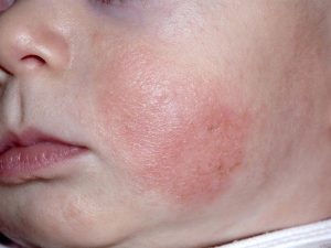 Vùng tổn thương chủ yếu xuất hiện ở 2 bên má