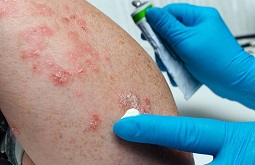 12 Thuốc Bôi Viêm Da Dị Ứng Hiệu Quả Nhất Bạn Nên Dùng